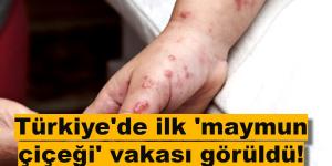 SAĞLIK BAKANI FAHRETTİN KOCA’DAN AÇIKLAMA! Türkiye’de ilk ‘maymun çiçeği’ vakası görüldü